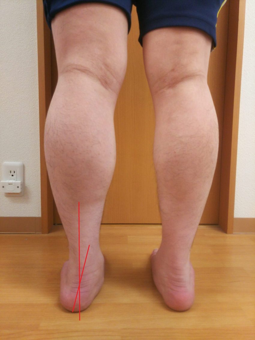 回内足①