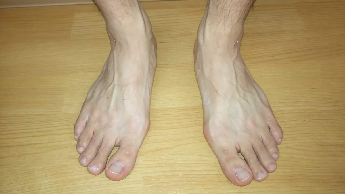 まだまだ誤解が多い 外反母趾になる原因 Foot Master