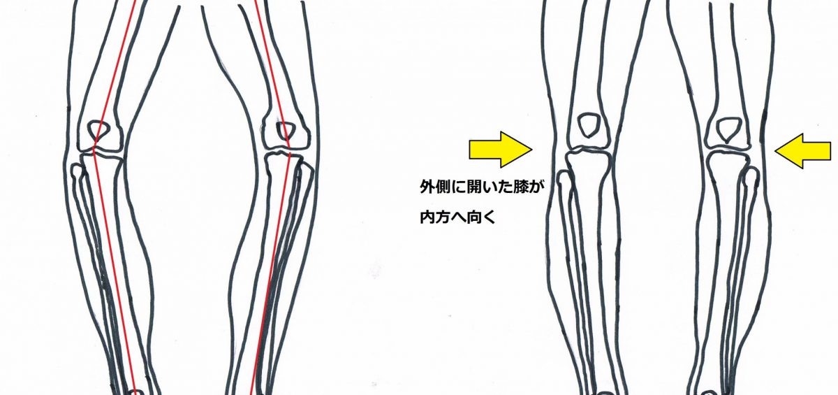 O脚矯正専用のインソールはありえない そのわけとは Foot Master O脚矯正専用のインソールはありえない そのわけとは Foot Master