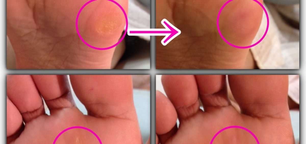 病院で治療したタコを再発させない方法 Foot Master